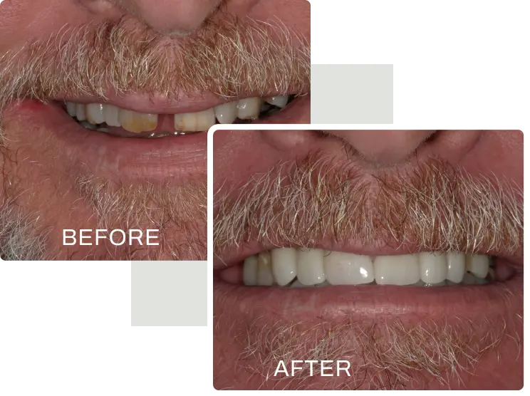 smile makeover before and after